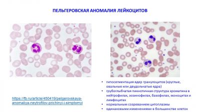 Пельгеровская аномалия нейтрофилов фото