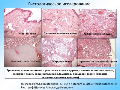 Тератома крестцово копчиковой области фото