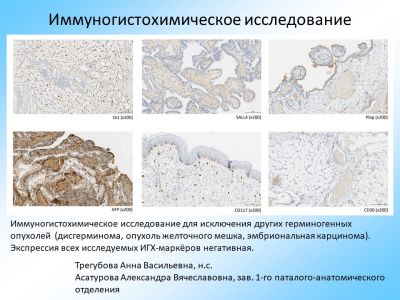 Тератома крестцово копчиковой области фото