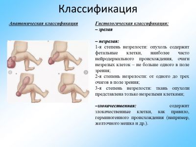 Тератома крестцово копчиковой области фото