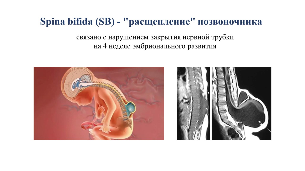 Новорождённые дети после внутриутробной коррекции spina bifida: клинический  случай и опыт наблюдения » Акушерство и Гинекология